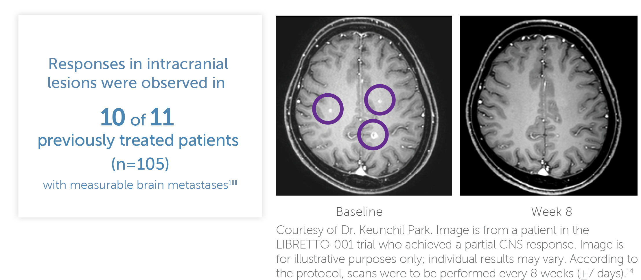 Responses in intracranial lesions were observed in 10 of 11 previously treated patients with measurable brain metastases